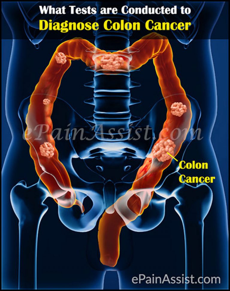 Diagnosis, Stages, Treatment of Colon Cancer or Cancer of the Colon