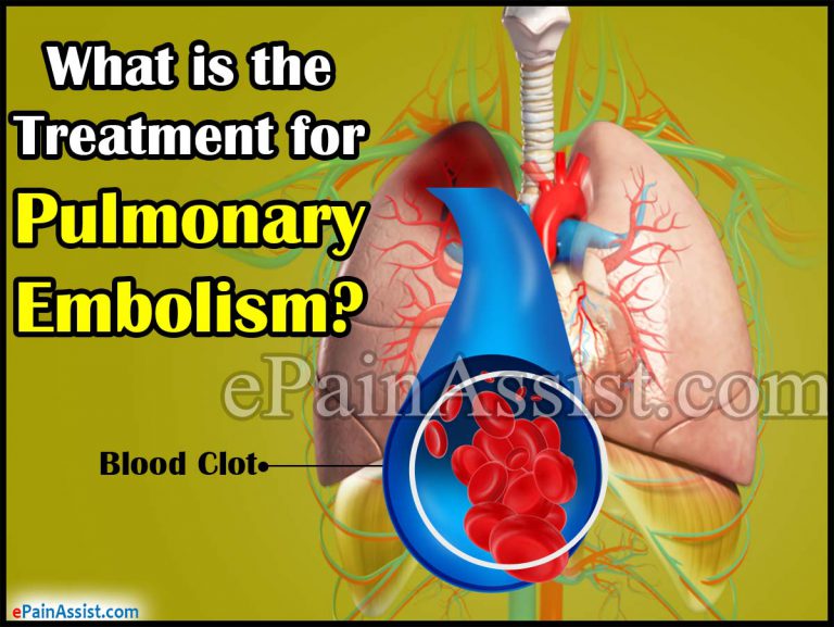 What is the Treatment for Pulmonary Embolism & How Long is its Recovery Period?