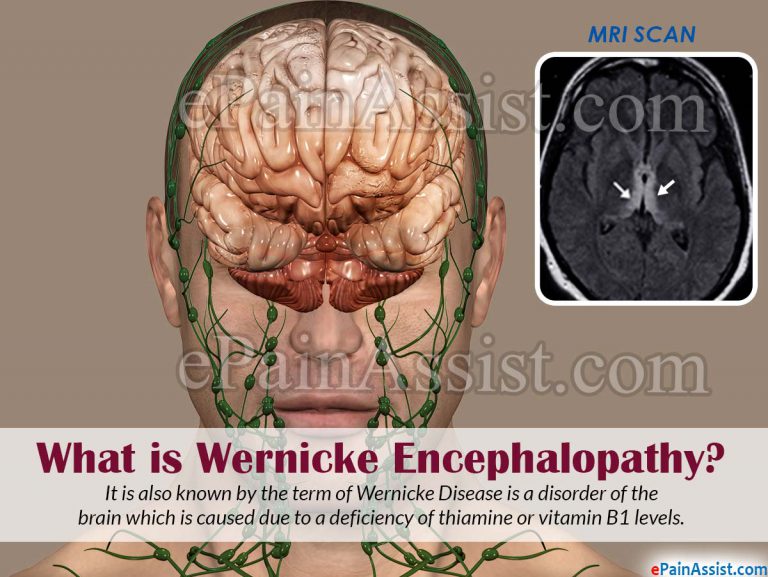 Wernicke Encephalopathy: Causes, Symptoms, Treatment, Prognosis