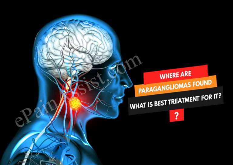 Where Are Paragangliomas Found & What Is The Best Treatment For It?