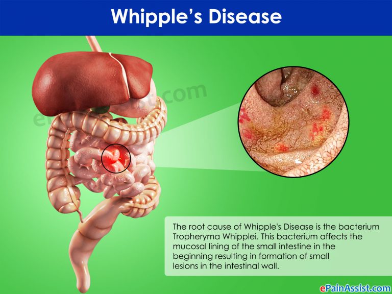 Whipple’s Disease: Causes, Symptoms, Diagnosis, Treatment