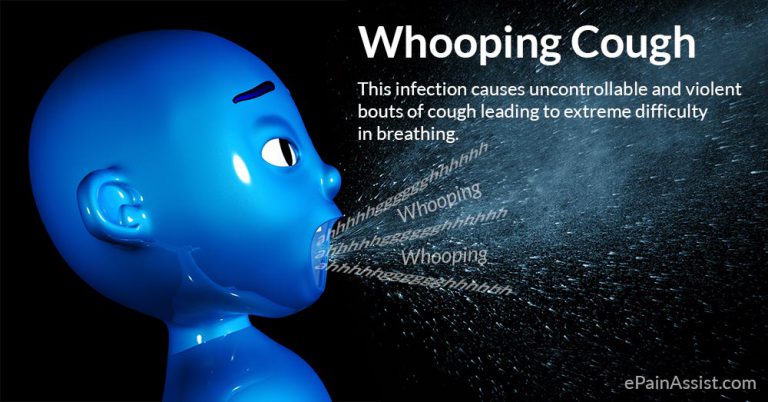 Whooping Cough or Pertussis: Causes, Symptoms, Diagnosis, Treatment, Complications