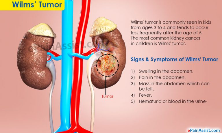 Wilms’ Tumor: Causes, Symptoms, Treatment, Stages, Survival Rate, Prognosis