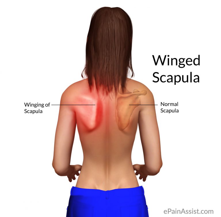 Winged Scapula or Scapular Winging: Causes, Symptoms, Treatment, Exercise, Diagnosis