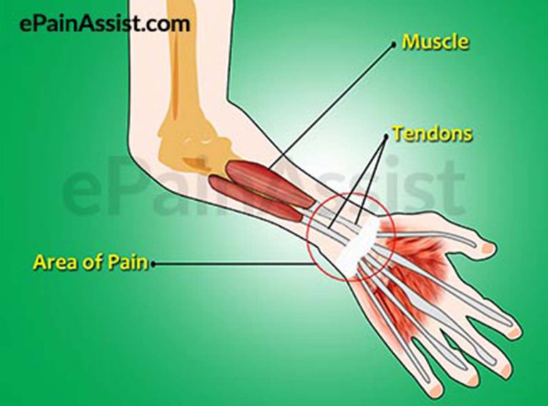 Wrist Joint Tendonitis: Causes, Symptoms, Treatment-Medications, PT, Surgery