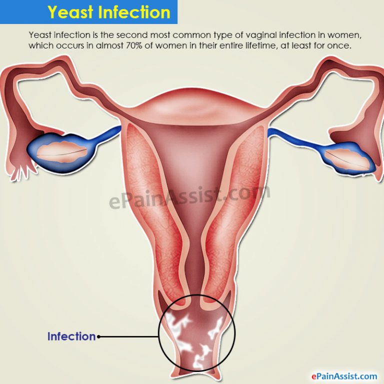 Ways to Prevent Yeast Infection