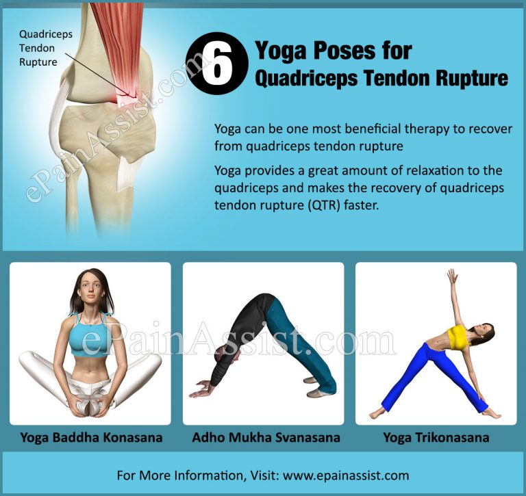 Quadriceps Tendon Rupture: Exercise, Yoga, Braces, Prognosis, Healing Time