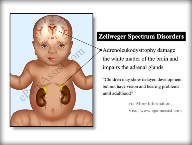 Zellweger Spectrum Disorders: Disease Mechanism & Causes