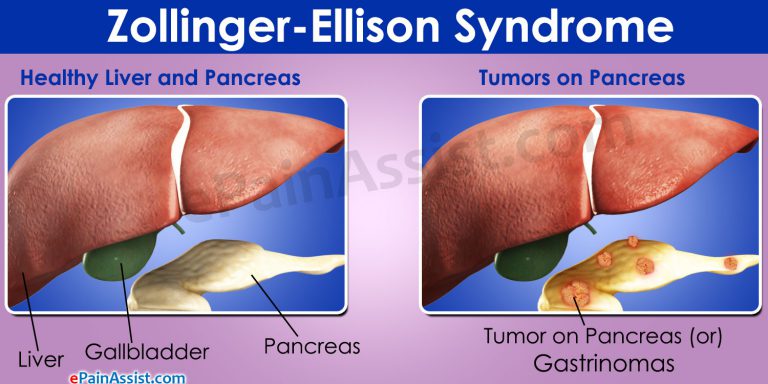 Zollinger-Ellison Syndrome: Causes, Symptoms, Treatment, Prognosis, Life Expectancy