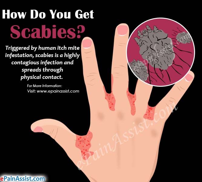 How Do You Get Scabies?