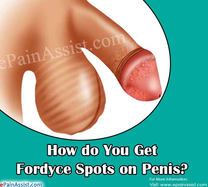 Fordyce Spots On The Penis 58