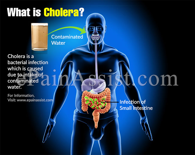 What is Cholera?