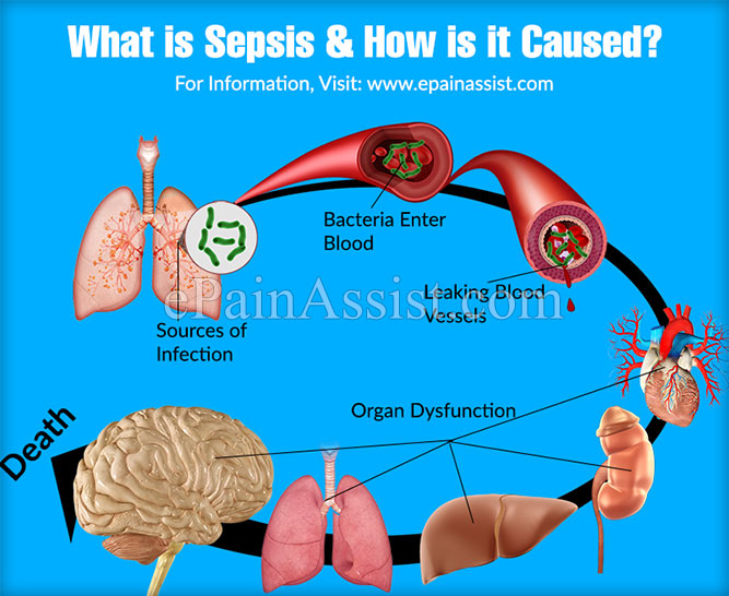 What is Sepsis & How is it Caused?