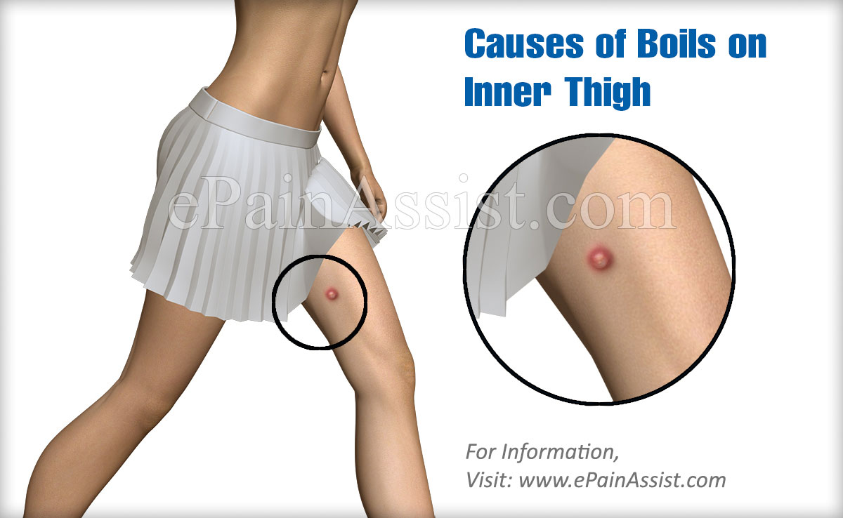 Causes of Boils on Inner Thigh