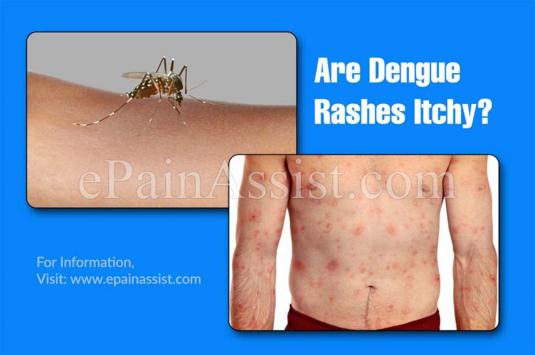 Are Dengue Rashes Itchy & How Long Does Dengue Last?