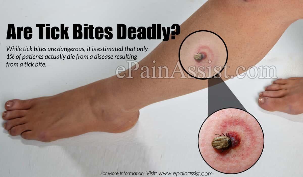 Are Tick Bites Deadly?