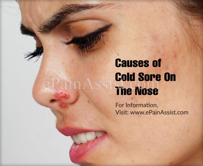 Causes of Cold Sore On The Nose & Its Treatment, Home Remedies