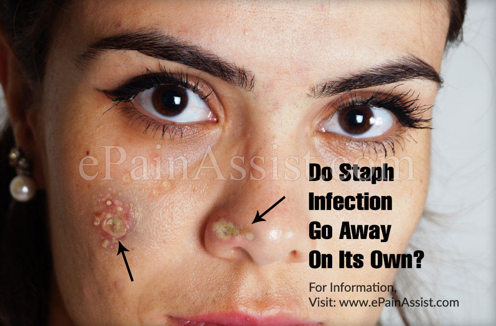 Do Staph Infection Go Away On Its Own?