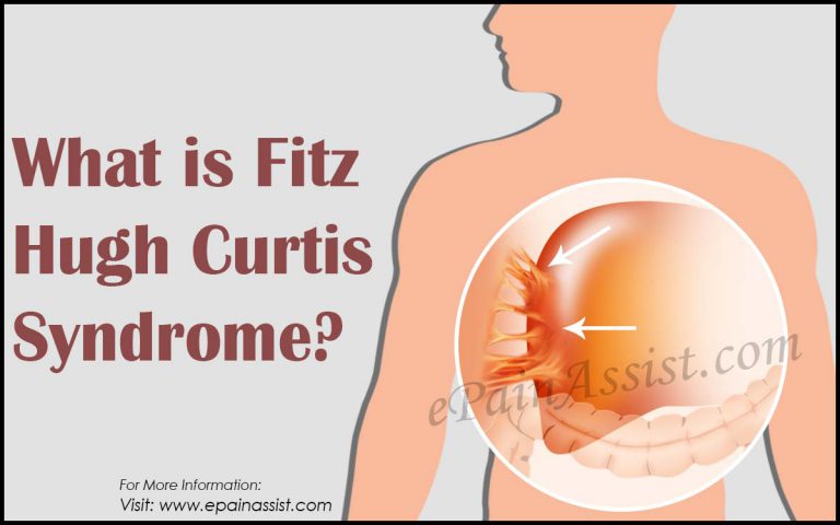 What is Fitz Hugh Curtis Syndrome: Causes, Symptoms, Treatment