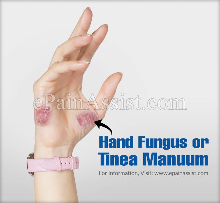 Hand Fungus or Tinea Manuum: Causes, Symptoms, Treatment, Prevention, Diagnosis