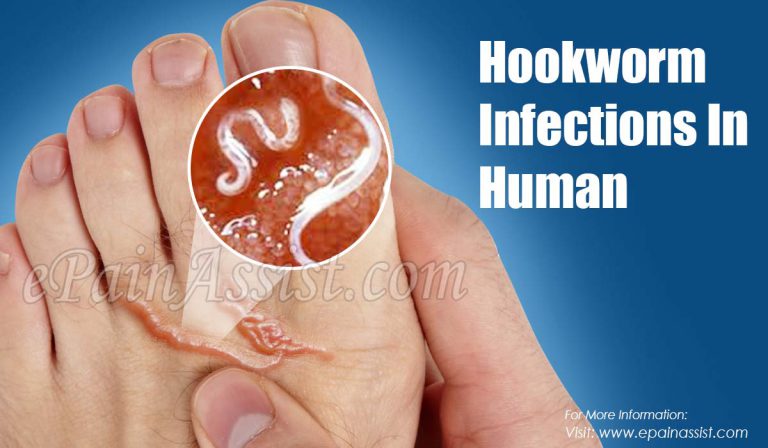 Hookworm Infections In Human: Causes, Symptoms, Treatments, Prevention, Diagnosis