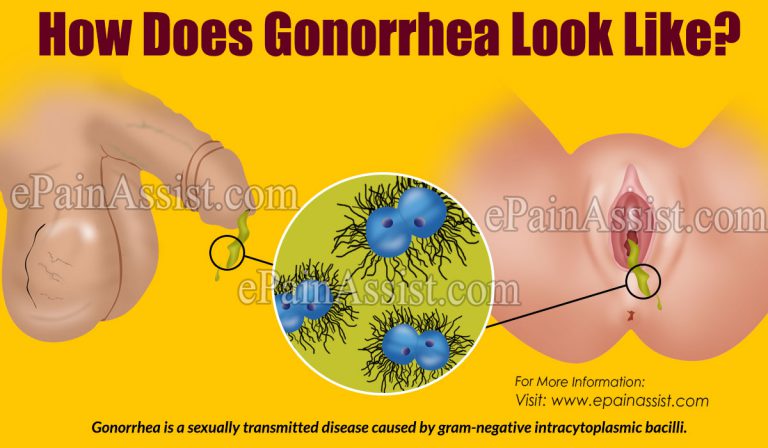 How Does Gonorrhea Look Like?