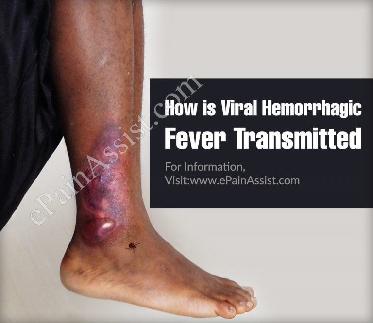 How is Viral Hemorrhagic Fever Transmitted & is it Contagious?