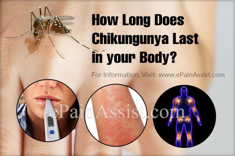 How Long Does Chikungunya Last in your Body & What is the Best Medicine for Chikungunya?