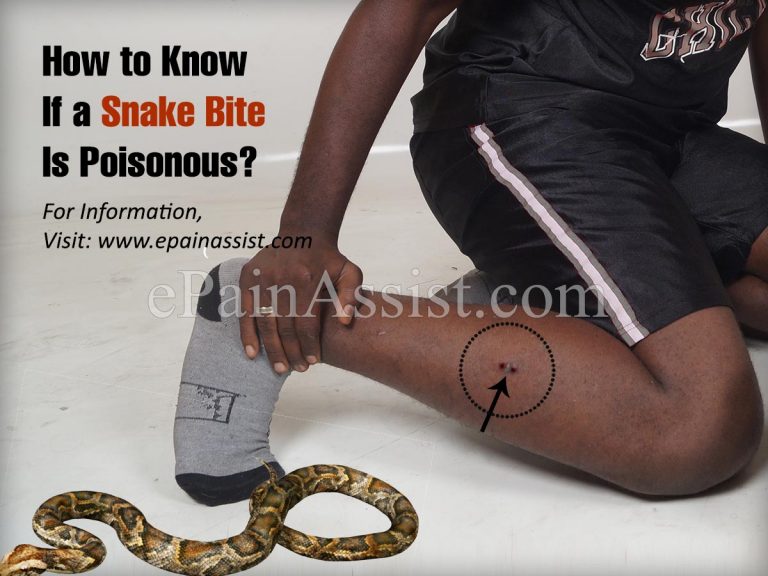 How to Know If a Snake Bite Is Poisonous?|First Aid & Treatment for Snake Bite
