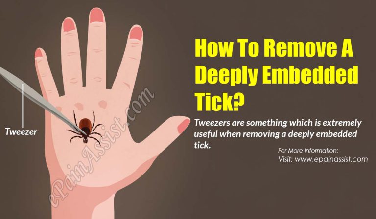 How To Remove A Deeply Embedded Tick?