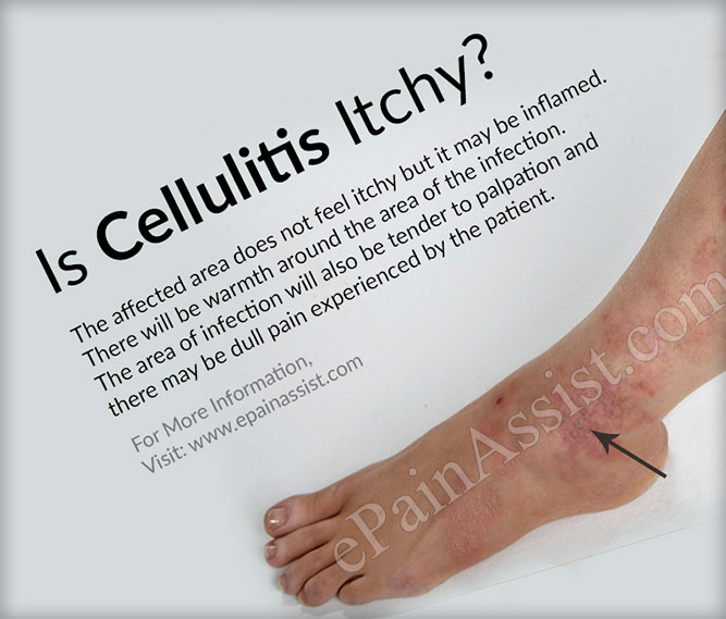 Is Cellulitis Itchy?