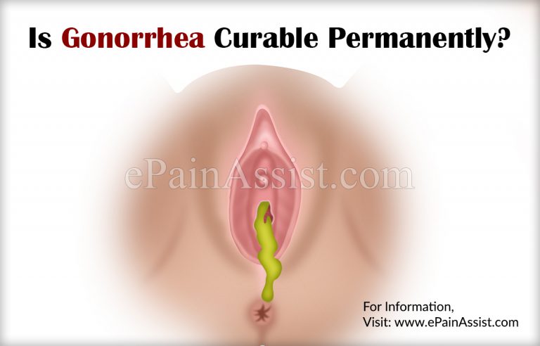 Is Gonorrhea Curable Permanently?