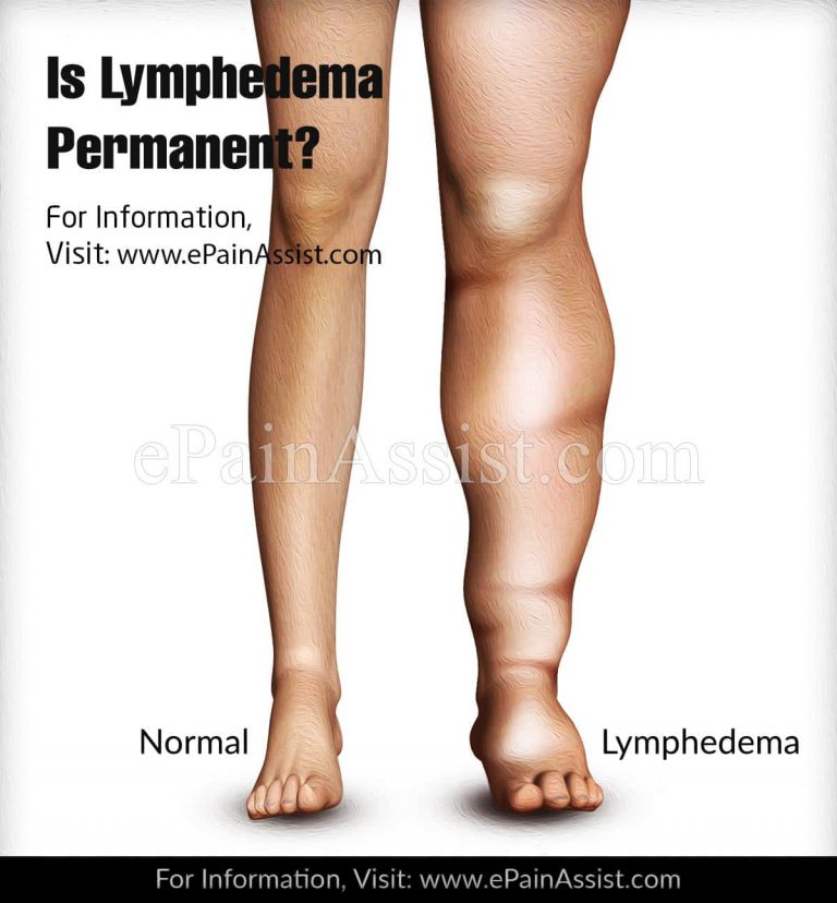Is Lymphedema Permanent?