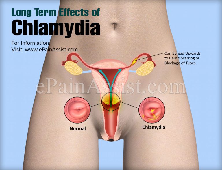 Long Term Effects of Chlamydia