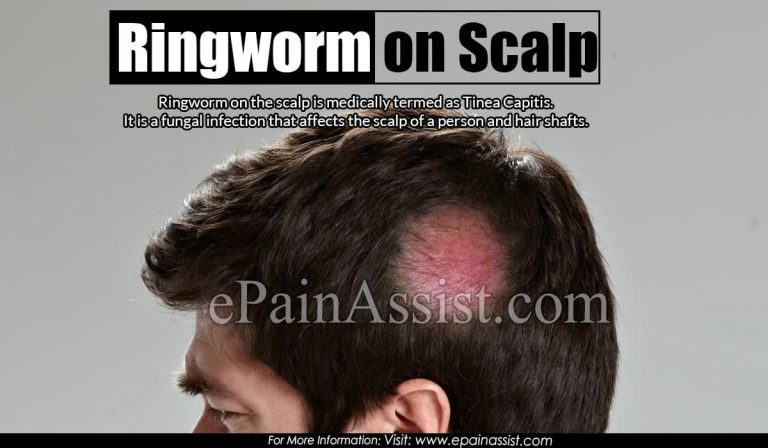 Ringworm on Scalp & Fastest Ways to Get Rid of it