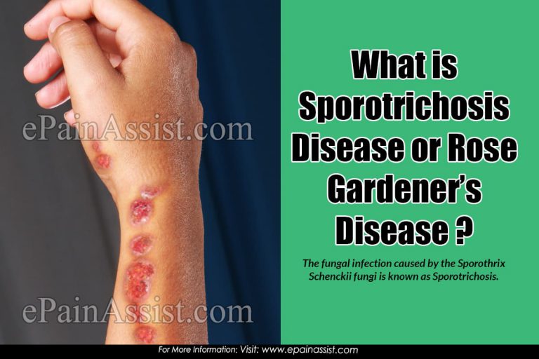 Sporotrichosis or Rose Gardener’s Disease: Types, Transmission, Symptoms, Treatment, Risk Factors, Diagnosis