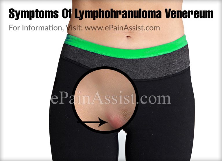 Lymphogranuloma Venereum: Causes, Symptoms, Treatment, Prognosis, Complications, Diagnosis