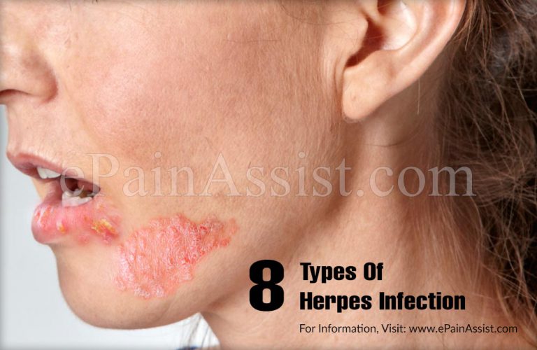 8 Types Of Herpes Infection & Ways to Decrease the Chances of Transmission of Herpes