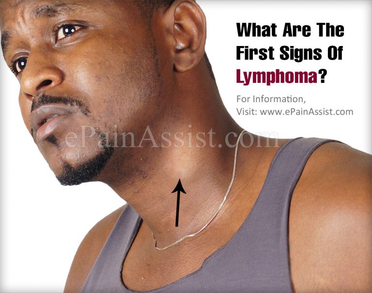 What Are The First Signs Of Lymphoma?