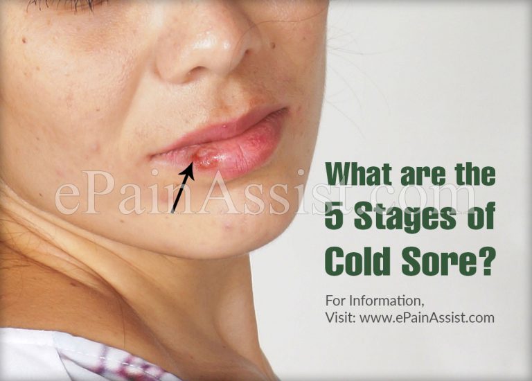What are the 5 Stages of Cold Sores & How to Get Rid of It?