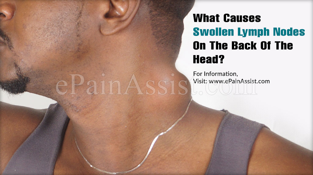 Swollen Lymph Nodes Back Neck