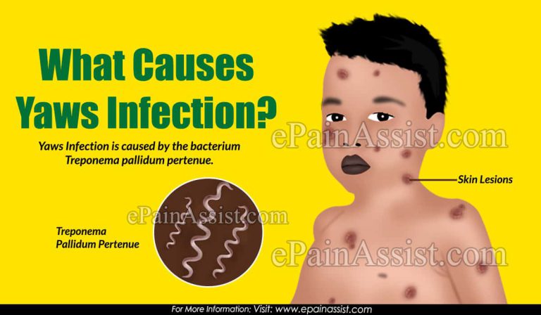 What Causes Yaws Infection & How is it Treated?|Stages, Symptoms of Yaws Infection