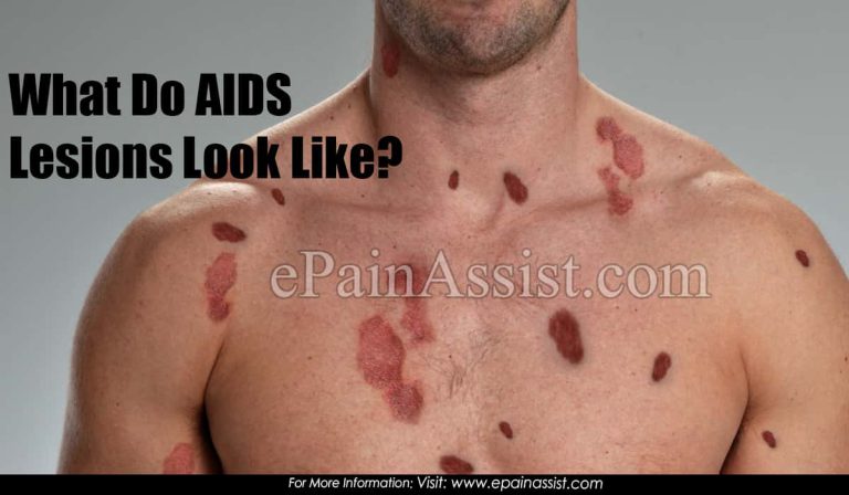 What Do AIDS Lesions Look Like?