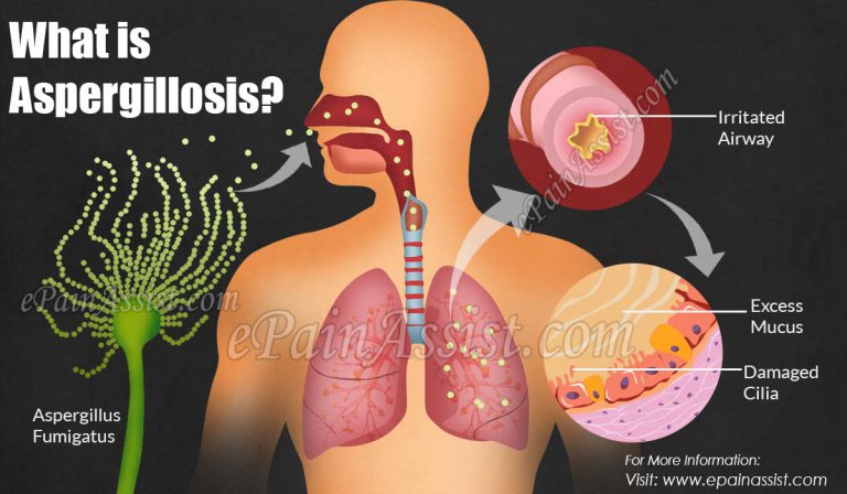 What is Aspergillosis: Types, Causes, Symptoms, Treatment, Prognosis, Prevention