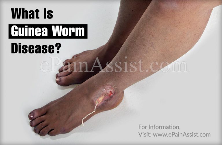 What is Guinea Worm Disease: Causes, Symptoms, Treatment, Diagnosis