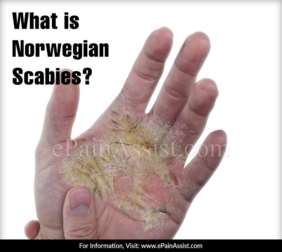 What is Norwegian Scabies?