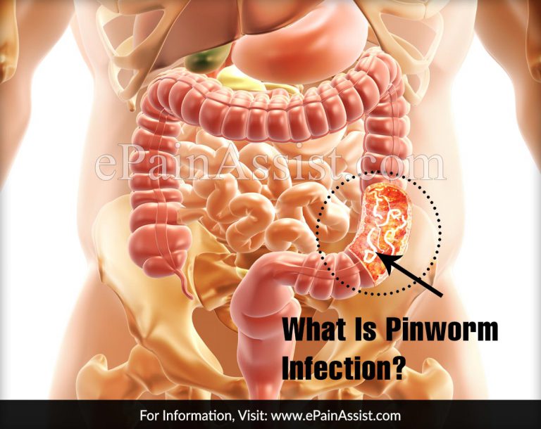 What is Pinworm Infection: Causes, Symptoms, Treatment, Risk Factors, Diagnosis
