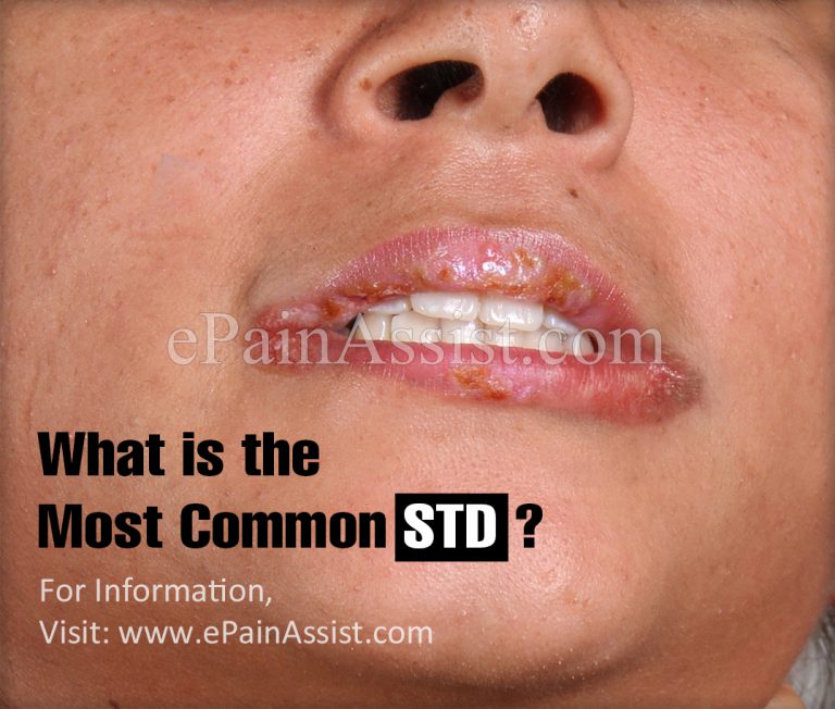 What is the Most Common STD?