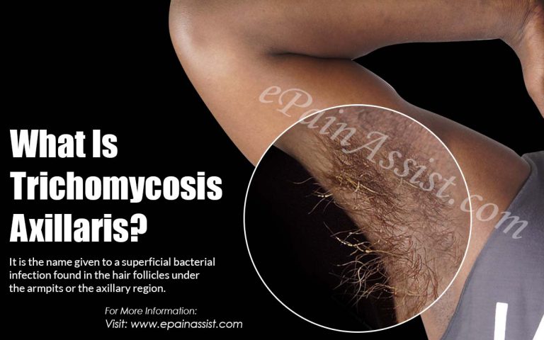 What is Trichomycosis Axillaris: Causes, Symptoms, Treatment, Prevention