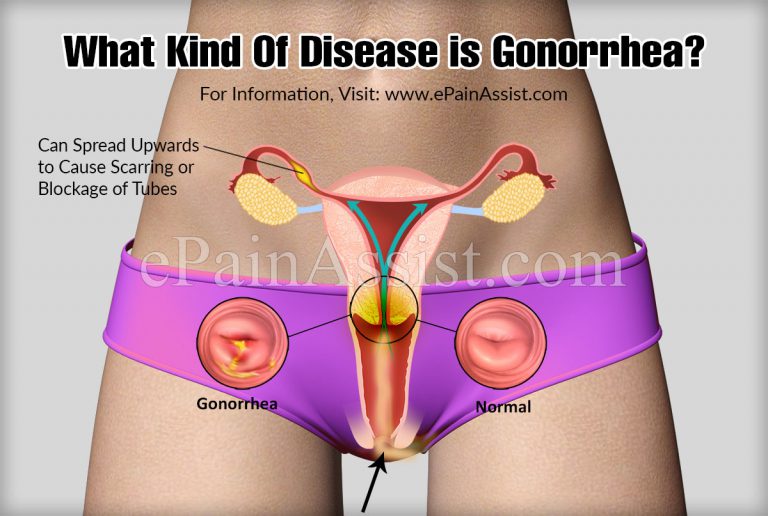What Kind Of Disease is Gonorrhea?